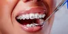 Dental braces in Tambaram