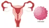 Chlamydia: Can it Cause Infertility?