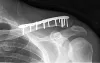 Clavicle (Collarbone) Fractures Treatment, Broken Collarbone | Siiora.com