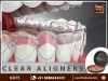 clear-aligners