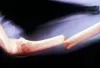 Indications and Clinical Management Of The Fractures