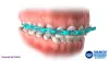 bracesbeforeandafterblog [licensed for non-commercial use only] / specialist orthodontist