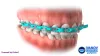 Find A Best Invisalign Center Near Me