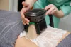 Does cool sculpting really work?