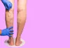 When Do You Need to Seek for Spider Vein Treatment?