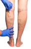 Be Required To Call Specialists If Having Varicose or Spider Veins?