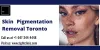 Skin Pigmentation Removal Toronto