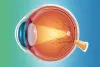 Cornea Specialist In Gurgaon | Cornea Diseases Treatment