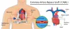 coronary-artery-bypass-graft-cabg.jpg