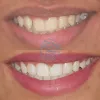 Cosmetic dentist in Mumbai - Cost of cosmetic dentistry - Smile Store