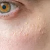 Cost of Milia Treatment in Dubai | Dynamic Clinic
