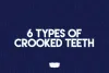 Invisalign, as Explained by a Dentist in Singapore