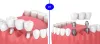 Crowns, Bridges and Veneers - Seville Dental | Book Appt.