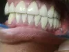 Dental Crowns and Bridges | Tooth Cap Price in Pune | Clinic Near Me