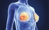 Symptoms Of Breast Cancer - Causes & Testing for breast cancer