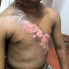 Treatment for Burns, Burn Scar, Burn Scar Treatment | Padanjali Ayurvedics