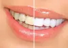  Dental Veneers  — Veneers vs. Lumineers- Which One is Suitable for...