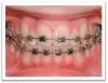 Can Orthodontics Treatment Damage The Teeth?