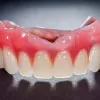 Problems and Failure Causes of Dental Implants – Site Title