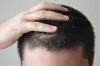 Best Dandruff Treatment at Bangalore | Dr. Health Hair Clinic