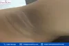 dark patches in armpits