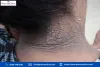 dark patches on neck