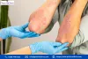 dark skin from eczema