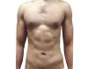 Home - Shanejohnson - Liposculpture VS. Liposuction: Which One Is The Finest For The Body?