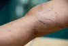Try These 5 Tips To Keep Vein Problems Away!