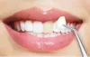 Dental Veneers Near Me :: VeneersDentist