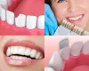 Dental Bonding Near Me