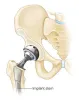 Manufacturer of Orthopedic Implants and Instruments | Siora Surgicals
