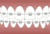Dental Braces – Complete Solution for a Healthy Smile & Much More