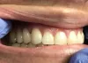 Dental Bridge Near Me | Cantilever Bridge Dental – Urbn Dental Midtown