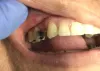 Dental Bridges Near me | Type of Dental Bridge Cost Houston | URBN Dental Midtown