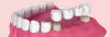 Dental Bridge Cost Near Me | Tooth Bridge Treatment In India