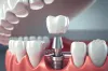 Get Natural-Looking Dental Implants in Tambaram at Balaji Dental Hospital