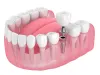 Dental Implant in India | Dental Implant Cost in India