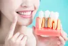 dental-implants