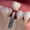 Important Factors Should Consider Before Having Dental Implants - MY SITE