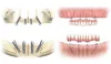 Dental Implants in in Shelby Township, MI
