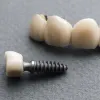Dental Implants Cost Houston – Cost of Full Mouth Teeth Implants Near Me