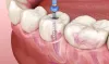 Harinavi's Healing Hub: Root Canal Treatment at Its Finest