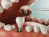 Dental Implants Cost in Gurgaon: A Guide by Cosmodontist Dental and Implant Centre