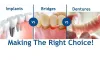 dental-implants