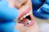 Root Canal Treatment at the best dental cinic in gurgaon | Irvin
