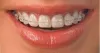 Teeth Implant Harinavi