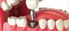 Dental Bridges Tacoma Wa - Tacoma Dental Group