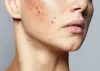 Clear Your Skin Effective Ways to Treat Lichen Planus on Face