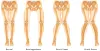 Development of Angular Deformities 